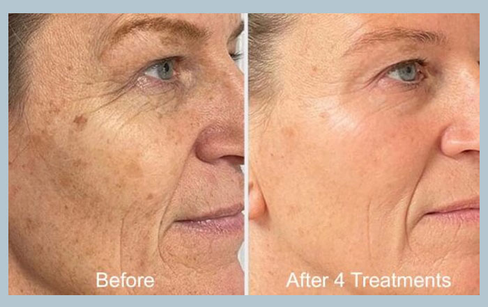 Procell Microchanneling